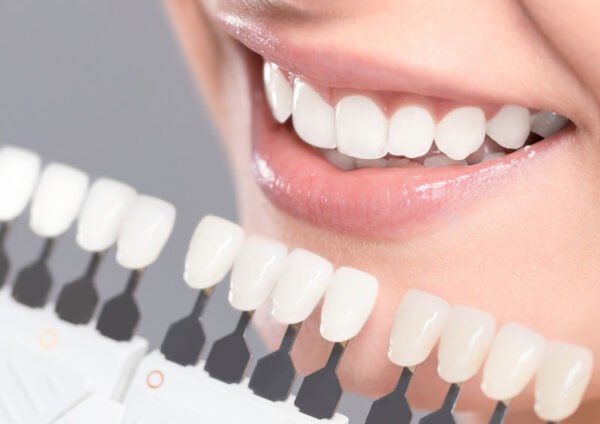 porselen-lamine-dis-izmir